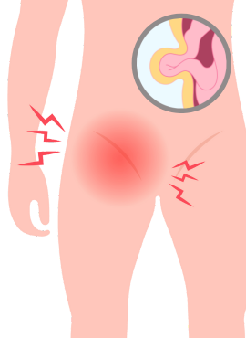 Cirugía de Hernia Inguinal Cirugía de Hernia Inguinal en Comalcalco
