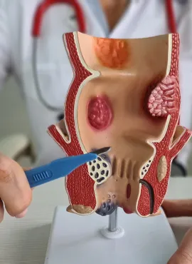 Especialista en Sangrado Anal Especialista en Sangrado Anal en Comalcalco