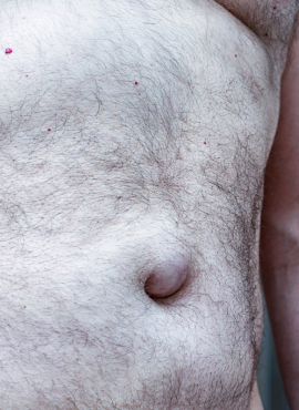 Cirugía de Hernia Umbilical en Comalcalco
