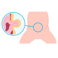 Clínica de Hernia en Comalcalco