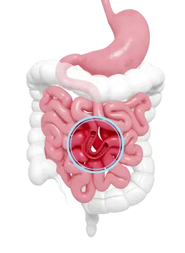 Oclusión Intestinal en Comalcalco