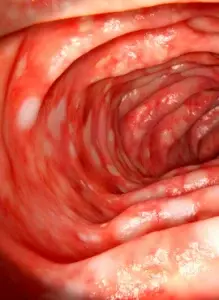 Oclusión Intestinal en Comalcalco